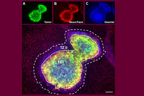 VOGIM: Tumour-induced cell death and tumour zones I and II. The tumour is shown in green, damaged neurons are shown in red and cell nuclei are shown in blue. There are at least two distinct tumour zones (TZ I and TZ II) visible.
