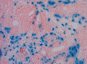 Microscopic image of a tissue section through a bowel tumour