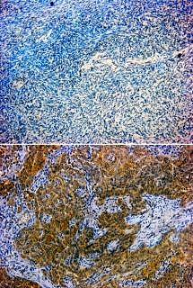 The top image shows human ovarian tissue. The blue colouring shows the individual cell nuclei. The brown colouring in the bottom image shows the activation of an endogenous retrovirus gene. (Image: PD Dr. Strissel/PD Dr. Reiner Strick)