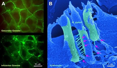 (A) Healthy epithelial tissue compared with infected epithelial tissue (green) in the human stomach destroyed by Helicobacter pylori. (B) Three magnified bacteria (light green) viewed under an electron microscope. Red arrows indicate the protruding ‘toxin needles’ through which, ultimately, cancer can be induced. (Images: A FAU/Prof. Steffen Backert, Aileen Harrer; B: Prof. Manfred Rohde (HZI, Braunschweig))