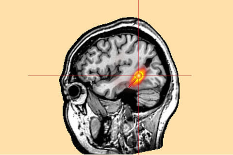 Magnetoencephalography (MEG) image