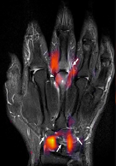 Recognizing arthritis in an MRI scan