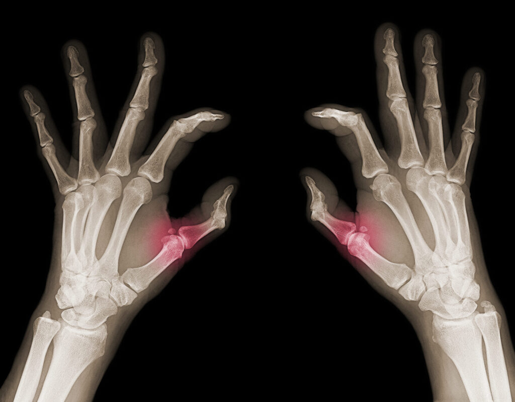 X-Ray of two hands