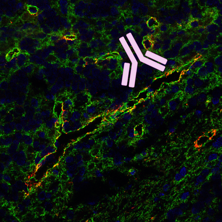 Rare neurological autoimmune disorder: MLC1 antibody identified as possible trigger